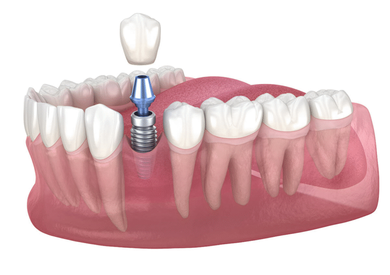 Affordable Dental Implants and Restoration Services Near Me